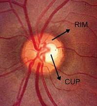 Normal-Optic-Nerve