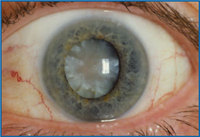 Mature-cataract