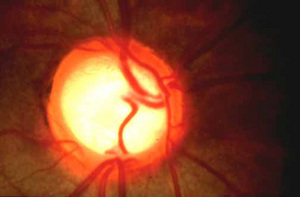 Optic-Nerve-With-Glaucoma