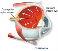 Glaucoma-Diagram