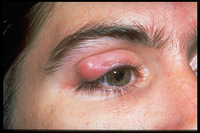 Chalazion