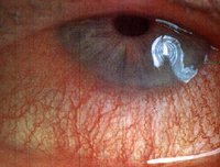 Red-Eyes-Equal-Dry-Eyes