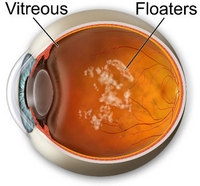 Floaters are suspended in the vitreous humor.